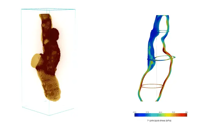 Comparison of carotid stress analyses with and without residual strains